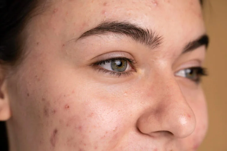 Traitement acné au dentifrice - remède de grand-mère efficace boutons visage