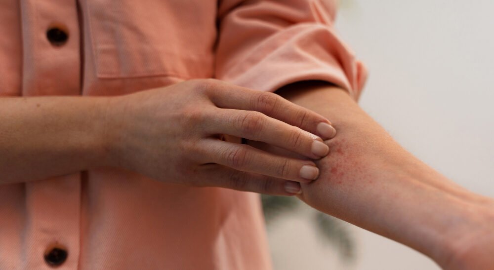 Personne présentant des réactions allergiques cutanées après la prise de PhenQ avec rougeurs et démangeaisons